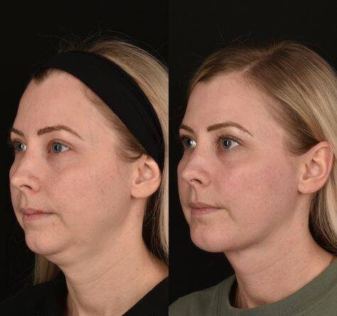 chin reduction surgery price