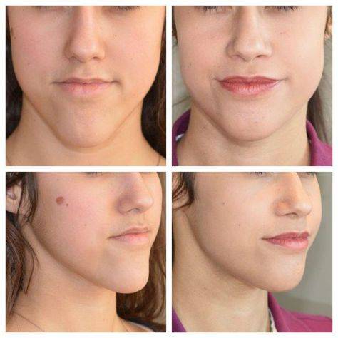 chin reduction surgery price