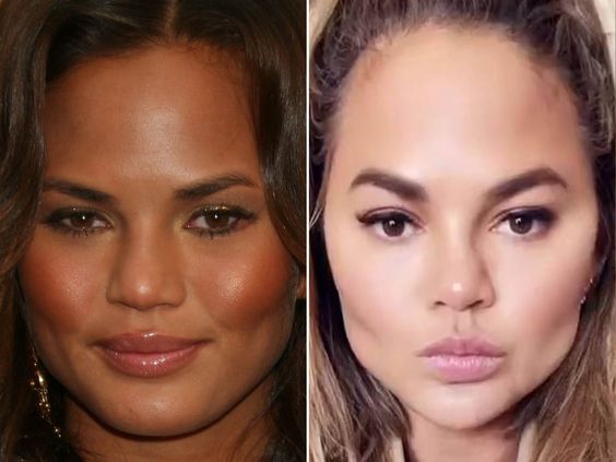 Chrissy Teigen Botched: Unpacking Her Beauty Evolution