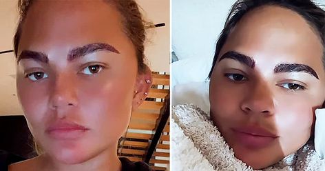 Chrissy Teigen Botched: Unpacking Her Beauty Evolution