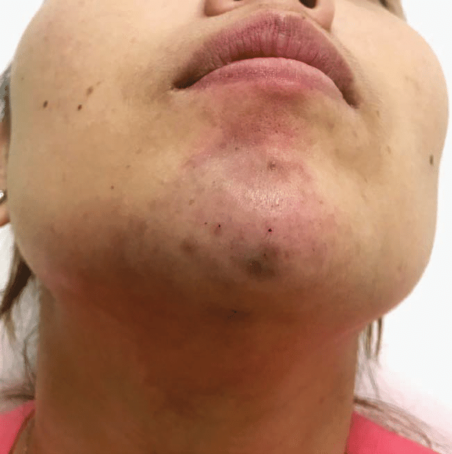 Complications of Jawline Filler for Jowls
