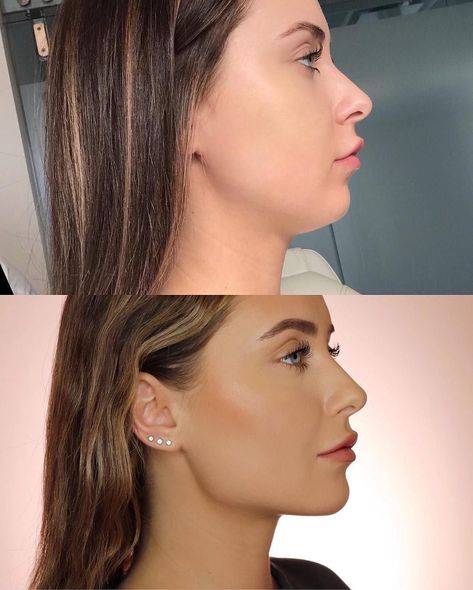 Cost of Chin Fillers: What to Expect for a Defined Jawline