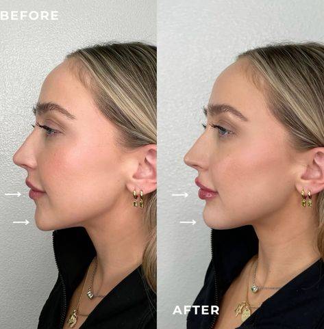 Cost of Chin Fillers: What to Expect for a Defined Jawline