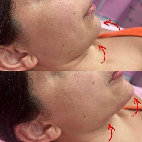 Cost of Chin Fillers: What to Expect for a Defined Jawline