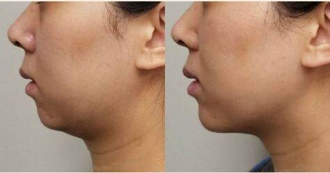 Cost of Chin Fillers: What to Expect for a Defined Jawline