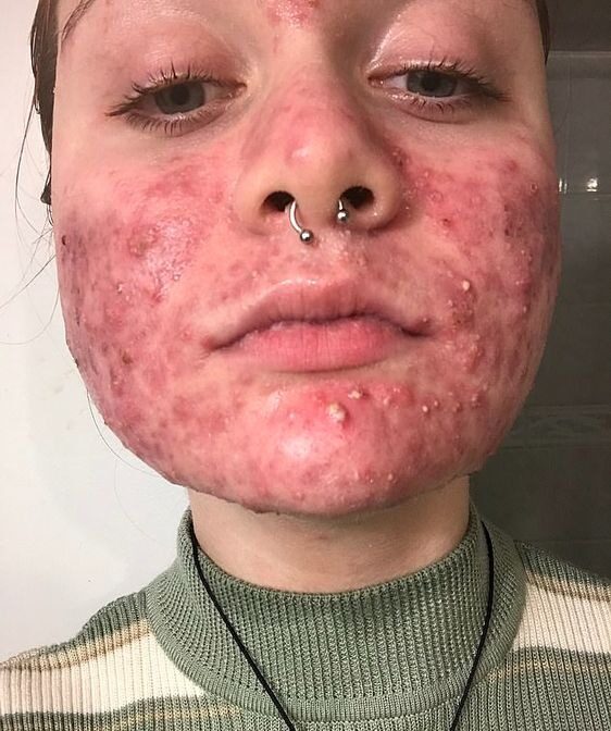 Cystic Acne