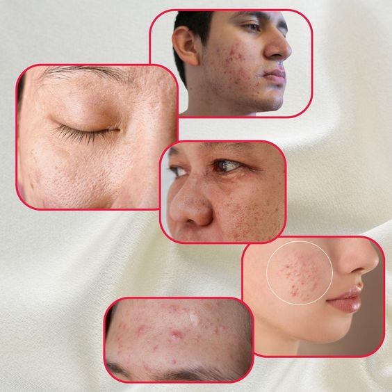 Cystic Acne Occur After a Chemical Peel