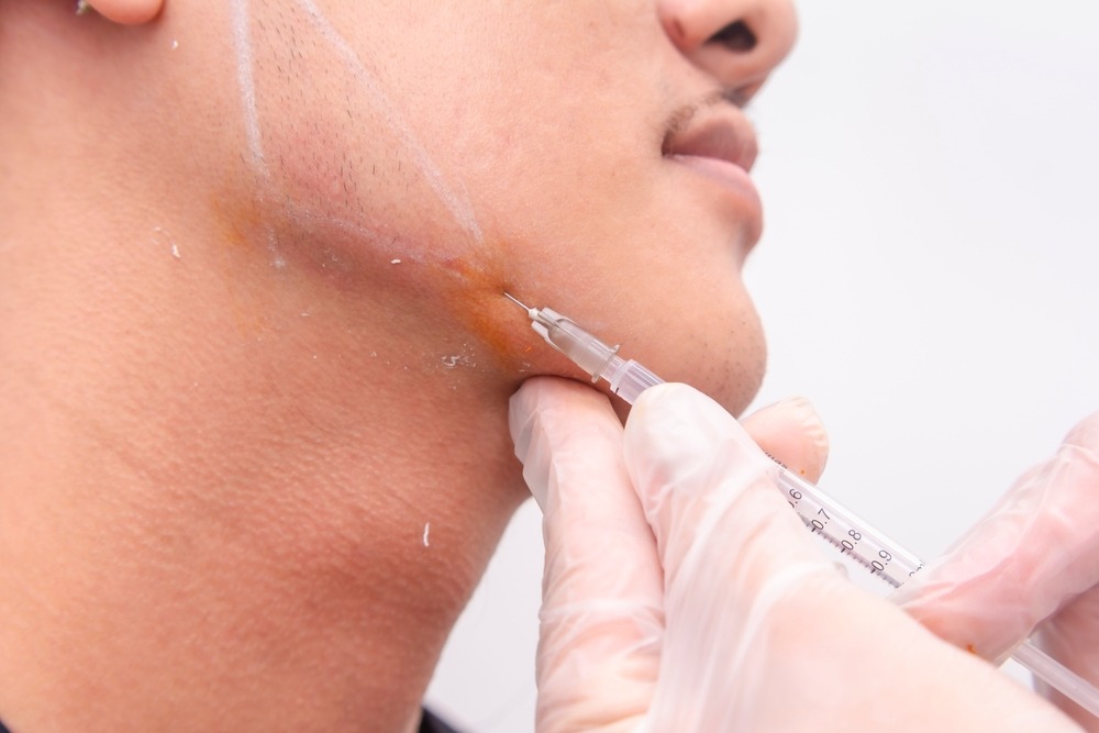 Dermal Fillers for Jawline Enhancement