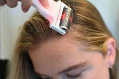 Dermaroller Hairline: Effective Solution for Hair Regrowth