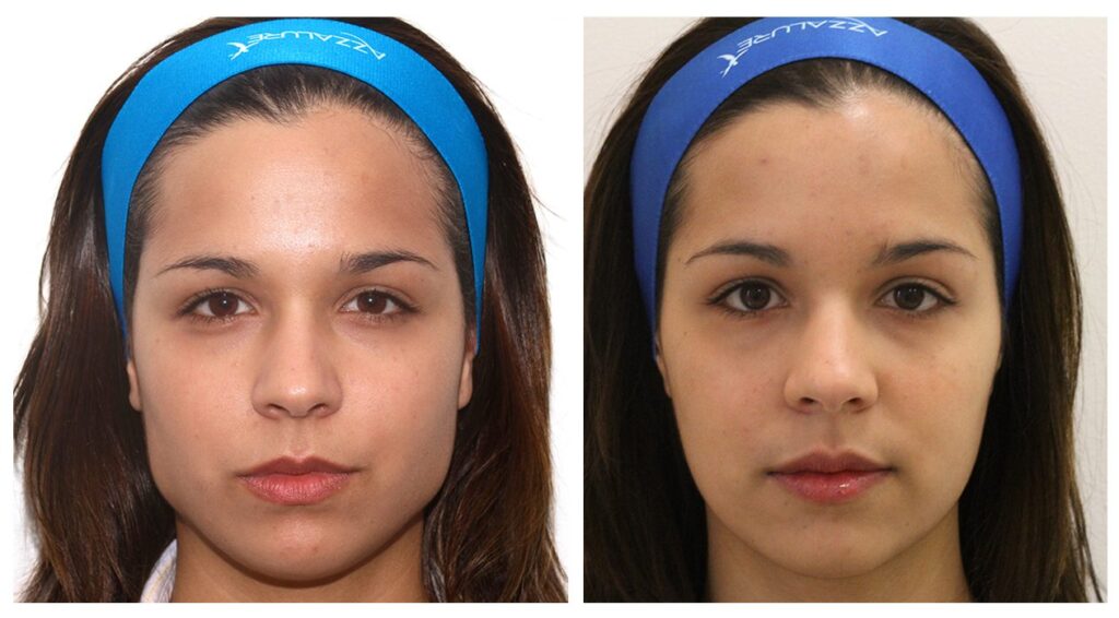 Desire for a Slimmer Face without Surgery