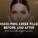 Dissolving cheek filler before and after