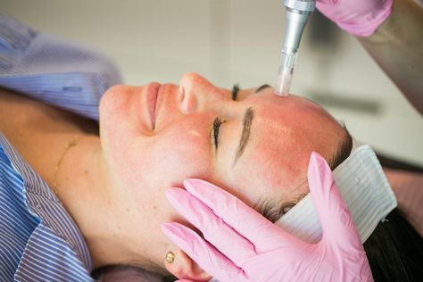 Downtime from Microneedling