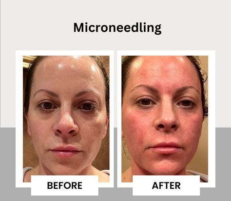 Downtime from Microneedling