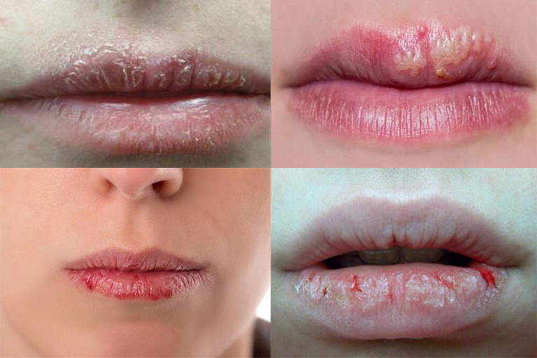 eczema of the lips