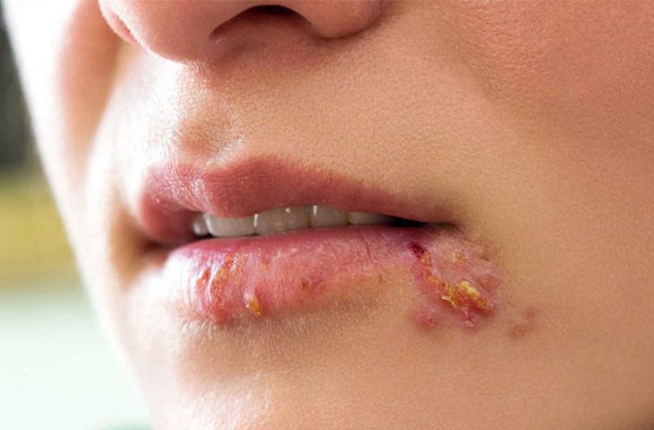 Eczema or angular stomatitis can cause similar symptoms.