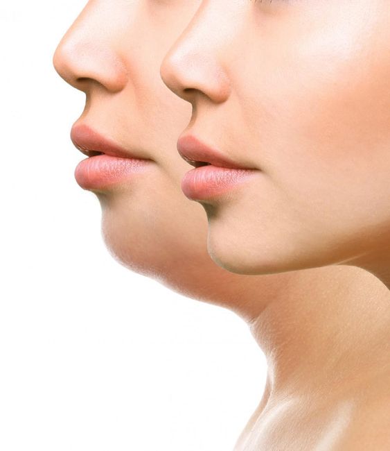  Effect Botox on the Jaw