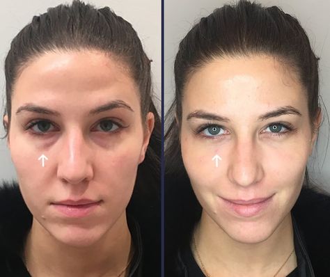 Eye Fillers Price: Understanding the Costs and Factors 