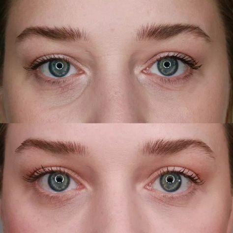 Eye Fillers Price: Understanding the Costs and Factors 