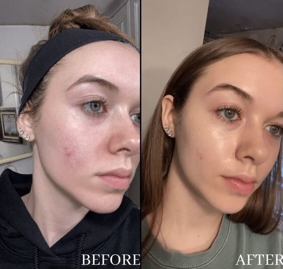 Facial Peels for Acne Before and After Results