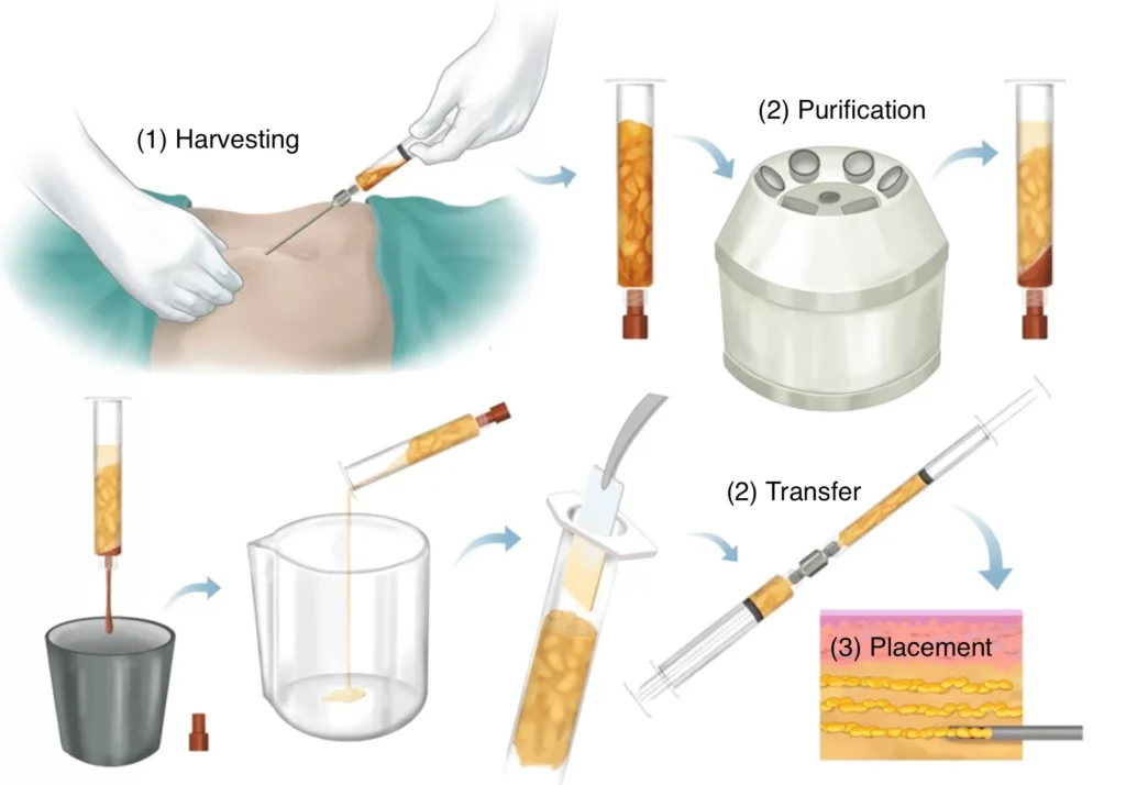 Fat Grafting Method