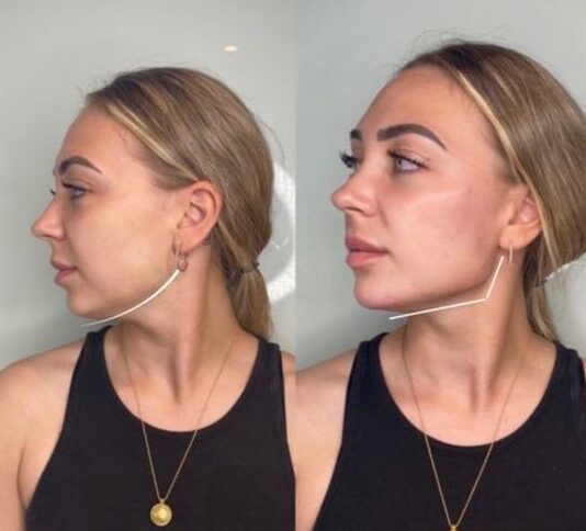 Female Jawline Filler