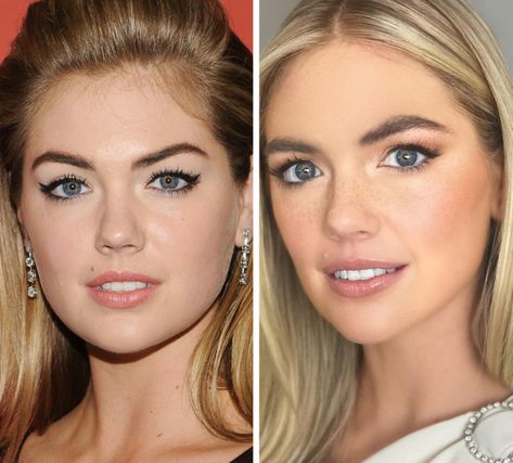 Filler Between Brows: Everything You Need to Know