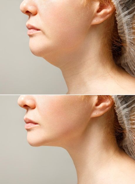 Filler in Chin Crease: Transform Your Look with Subtle