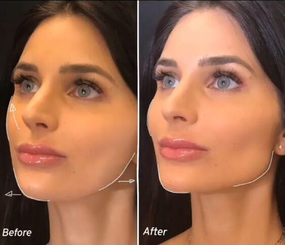 Filler in jawline before and after