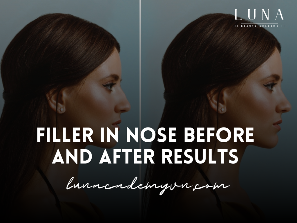 Filler in Nose Before and After