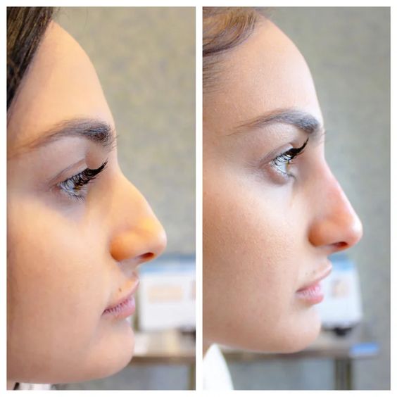 Filler in Nose Before and After