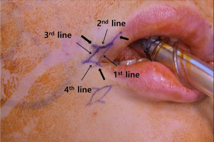 Filler Oral Commissures: Enhancing the Corners of Your Smile