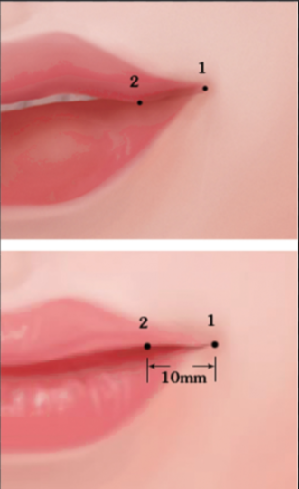 Filler Oral Commissures: Enhancing the Corners of Your Smile