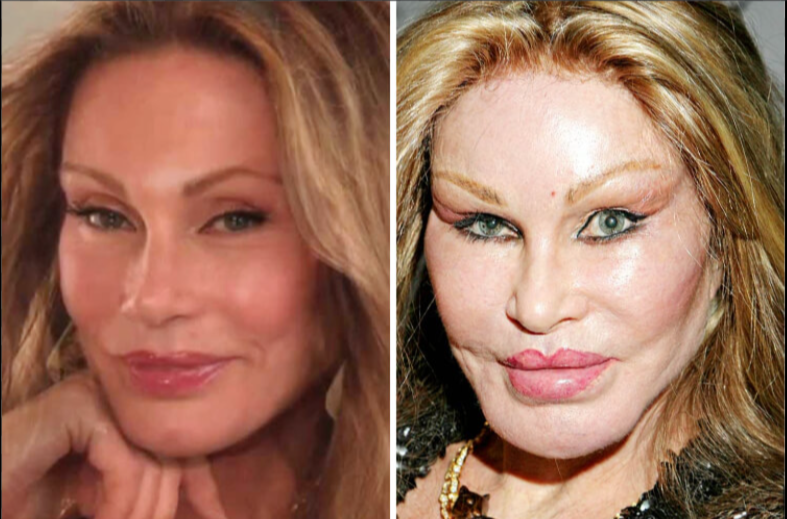 Fillers in Face Gone Wrong: What Happens When Cosmetic Procedures Fail?