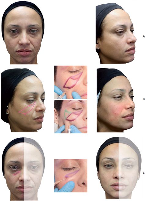 Fillers in Face Gone Wrong: What Happens When Cosmetic Procedures Fail?