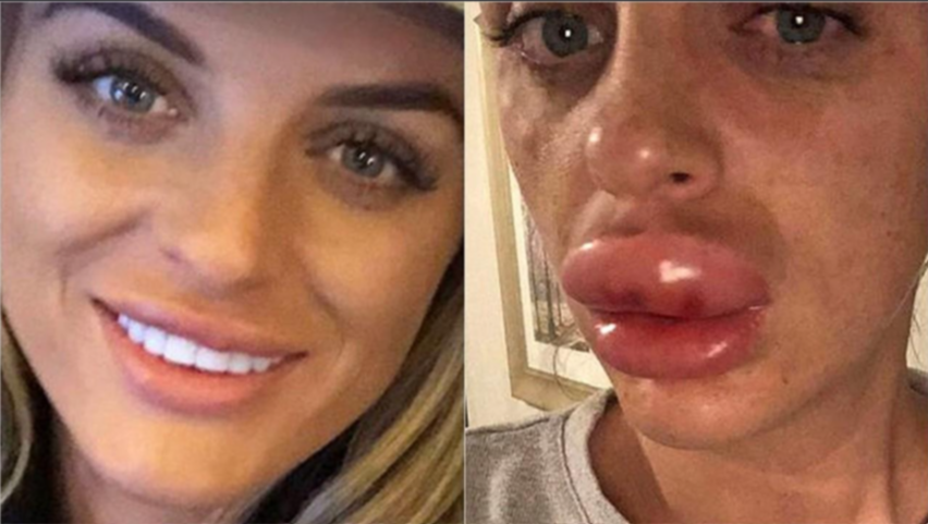 Fillers in Face Gone Wrong: What Happens When Cosmetic Procedures Fail?