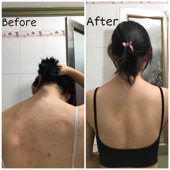 Glycolic Peel for back acne treatment at home