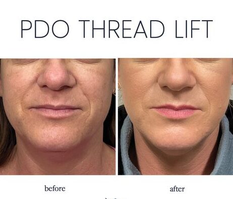 How Long Do PDO Thread Lifts Last?