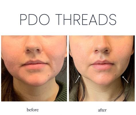 How Long Do PDO Thread Lifts Last?