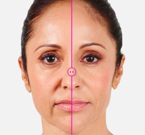 How Long Does Hyaluronic Acid Filler Last?