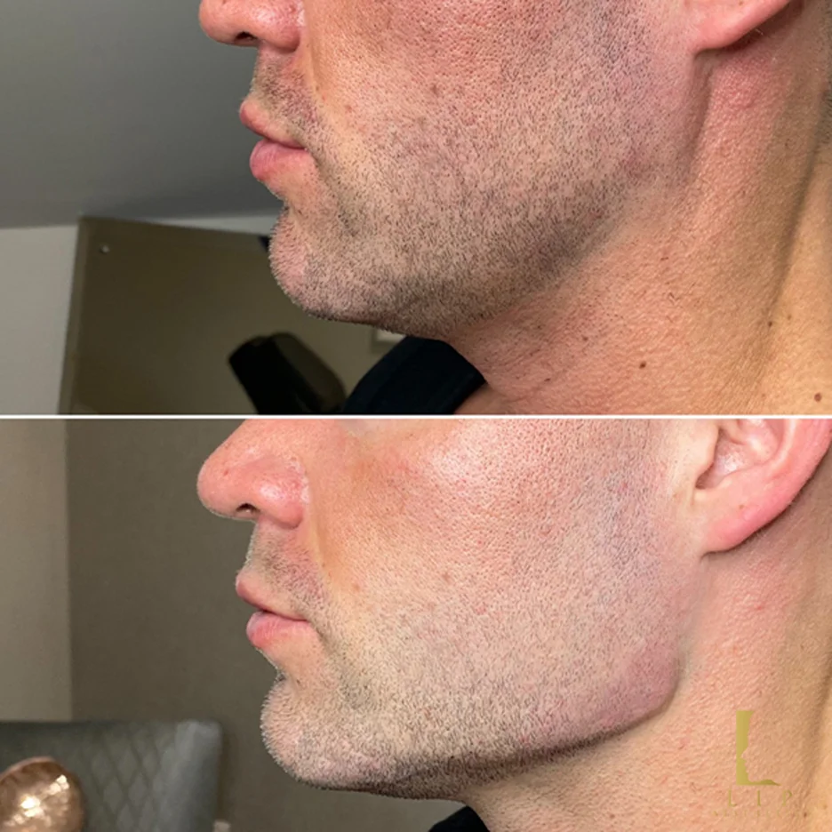 How long does jaw filler last?