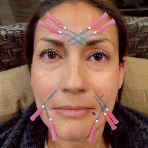 How Long Does Threading Last on Face?