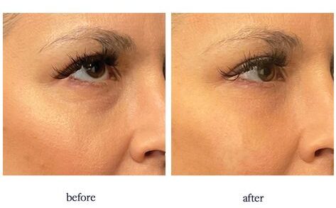 How Much Do Eye Fillers Cost?