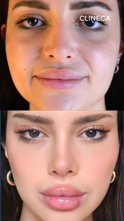 How Much Do Eye Fillers Cost?