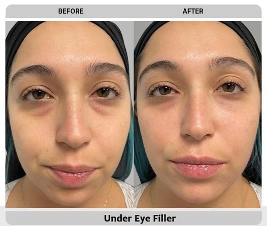 How Much Do Eye Fillers Cost?