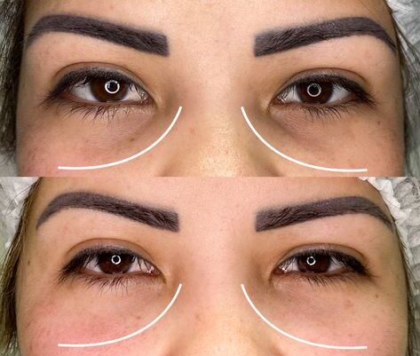 How Much Do Eye Fillers Cost?