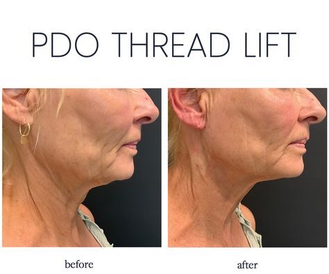 How Much Does an Eye Thread Lift Cost?