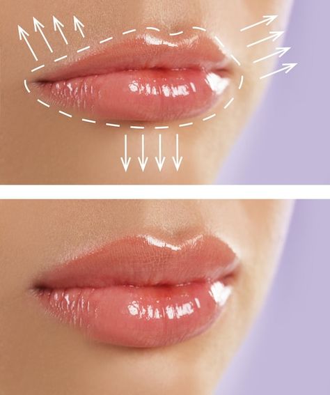 How Much is 1ml Lip Filler?