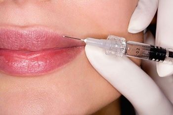 How Much is 1ml Lip Filler?