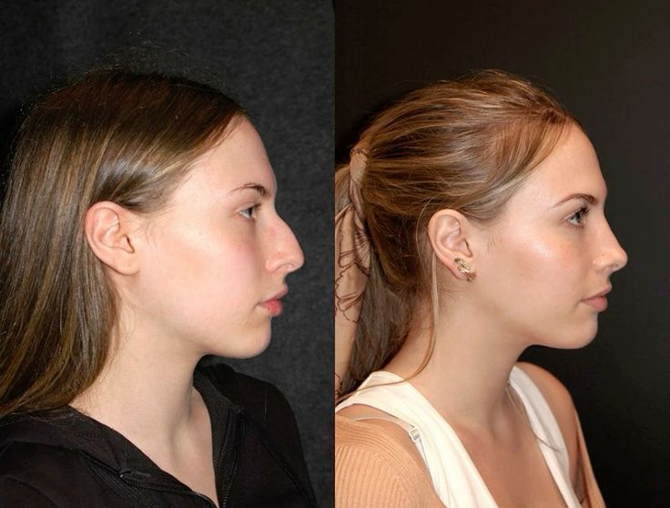 How Much Is a Chin Reduction Surgery?