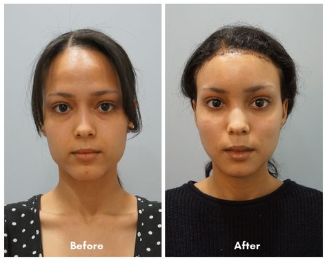 How Much Is a Chin Reduction Surgery?